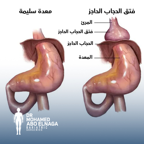 بالصور فتق الحجاب الحاجز